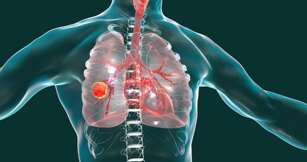 graphic of lung x-ray